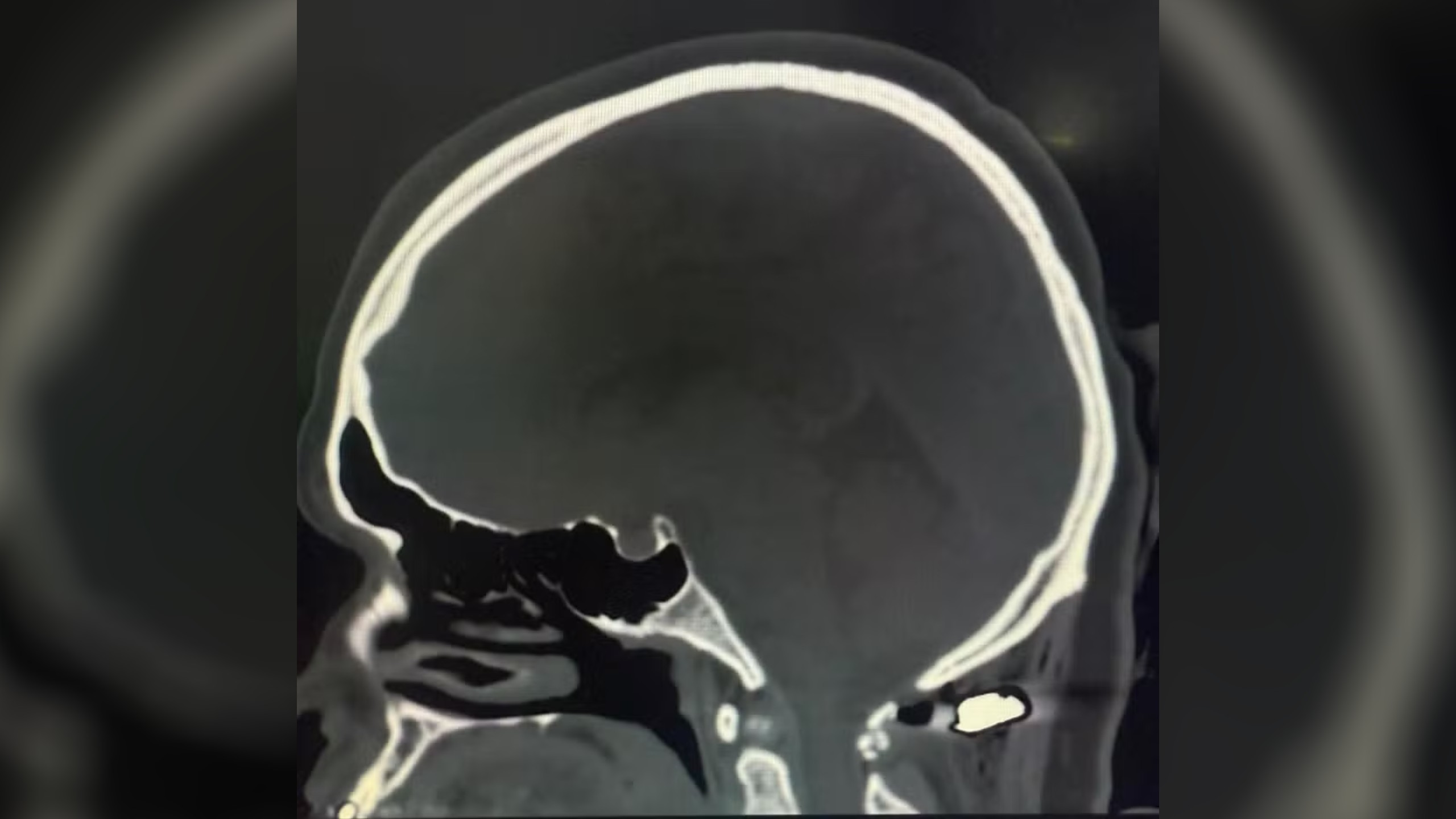 Mulher é baleada na nuca durante tiroteio em distribuidora de bebidas em Colombo